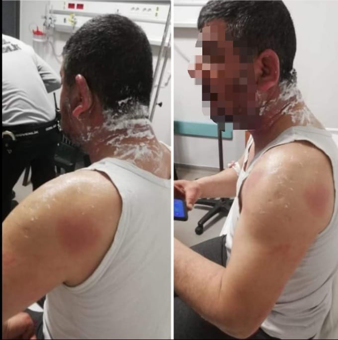 MHP'lilerden Asitli Saldırı...